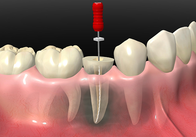 根管治療とは